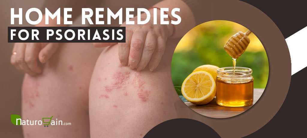 10 Best Home Remedies for Psoriasis That You [Really] Need to Know