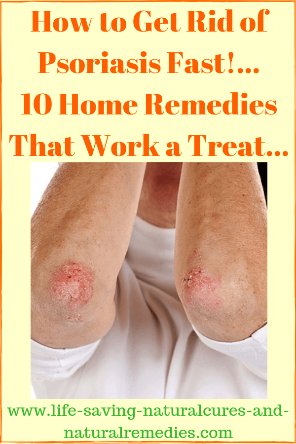 10 Powerful Natural Cures &  Home Remedies for Psoriasis ...