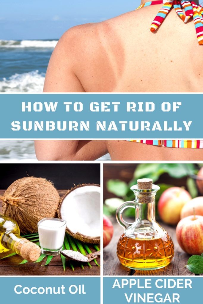 10 Ultimate Home Remedies To Get Rid Of Sunburn Overnight