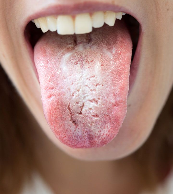 10 Ways To Get Rid Of White Tongue And Make It Healthier ...