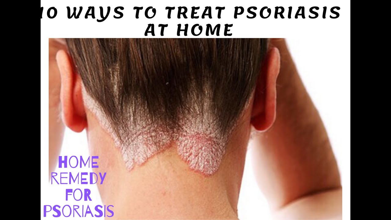 10 Ways to Treat Psoriasis at Home