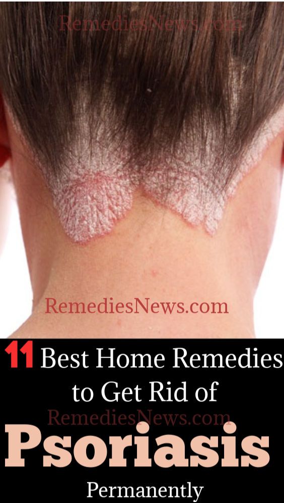 11 Best Home Remedies to Get Rid of Psoriasis Permanently