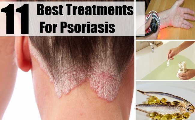 11 Best Treatments For Psoriasis  Natural Home Remedies ...