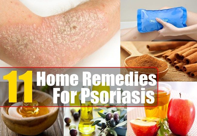 11 Home Remedies For Psoriasis