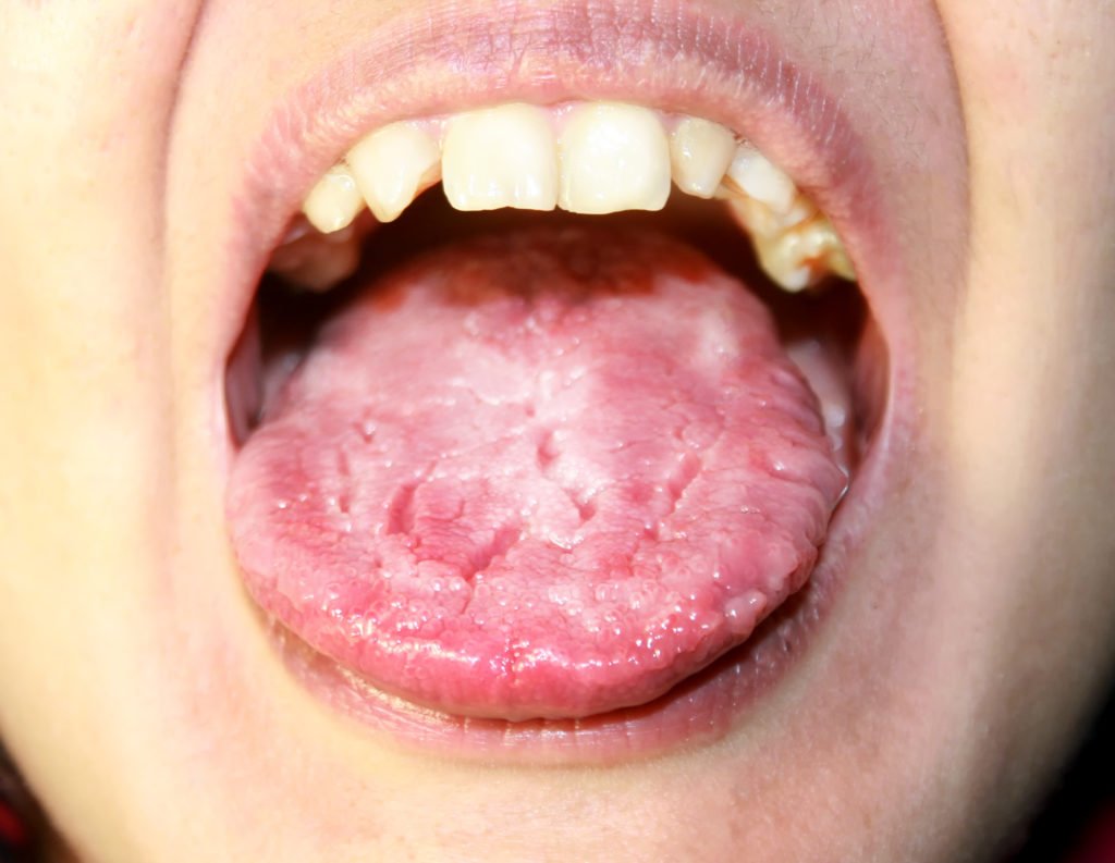111: What is Geographic Tongue? (Is It a Sign of Psoriasis?)