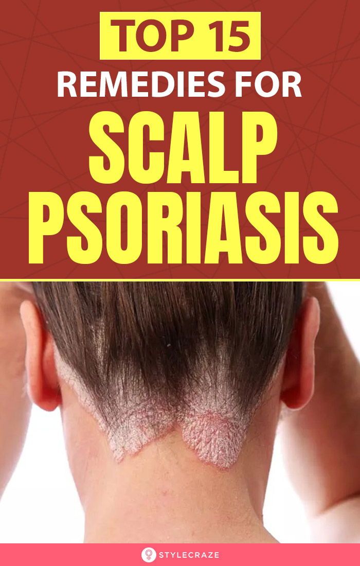 12 Best Home Remedies To Improve Scalp Psoriasis ...
