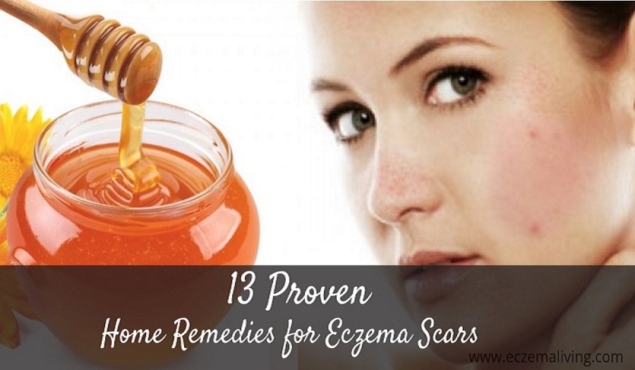 13 Proven Home Remedies To Get Rid of Eczema Scars