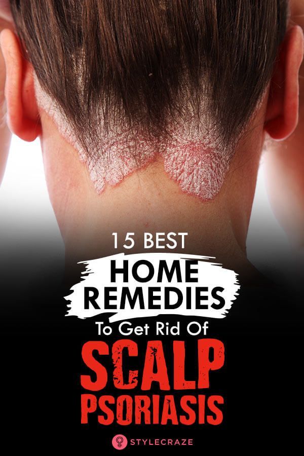 15 Best Home Remedies To Get Rid Of Scalp Psoriasis Effectively # ...