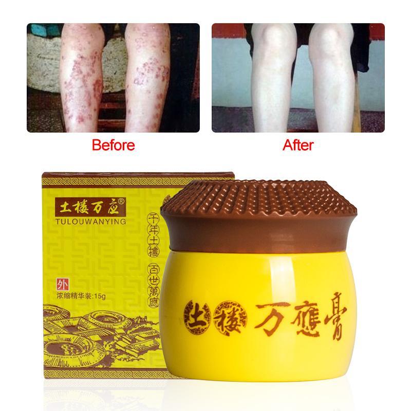15g Natural Mint Psoriasis Eczema Ointment Cream Skin Disease Eczema ...