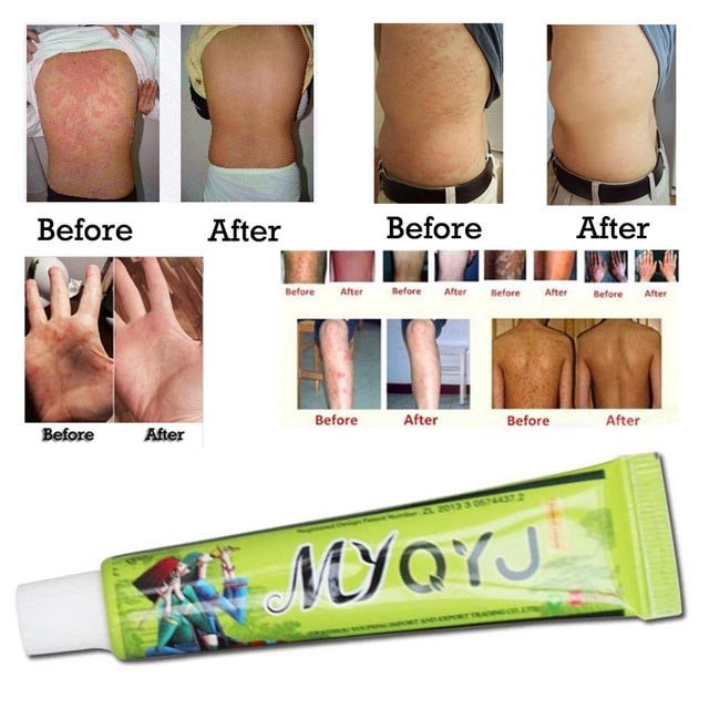 15g/box Hot sell Skin Psoriasis Cream Dermatitis ...