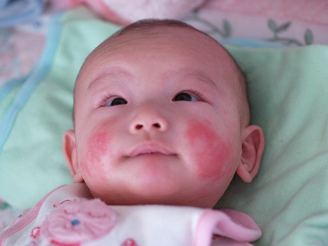 17+ images about MetaDerm Baby Eczema Moisturizing Cream ...