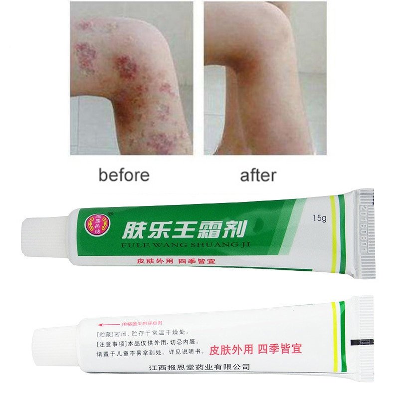 1PC Skin Psoriasis Cream Dermatitis Eczematoid Eczema ...