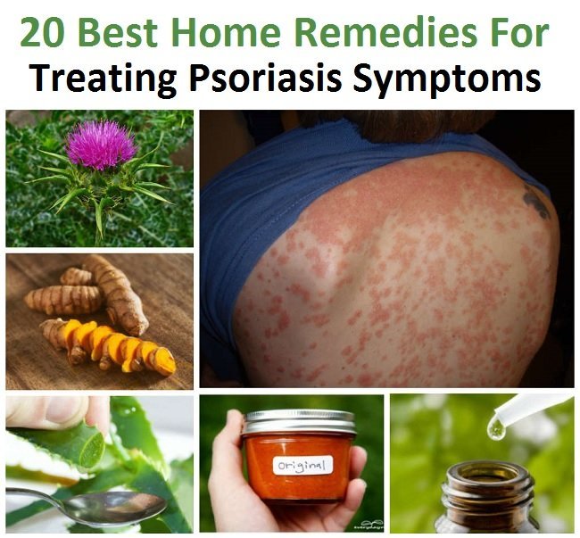 20 Best Home Remedies For Treating Psoriasis Symptoms