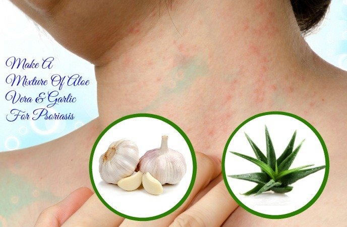 21 Home Remedies For Psoriasis On Face, Hands, Legs &  Scalp