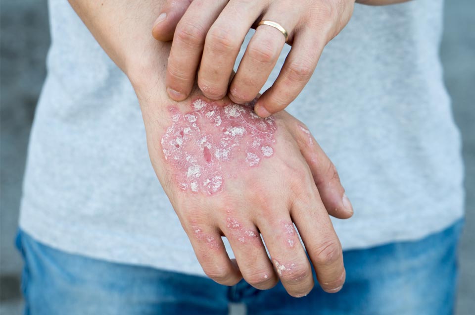 3 Home Remedies to Get Relief from Painful, Itchy Psoriasis Patches