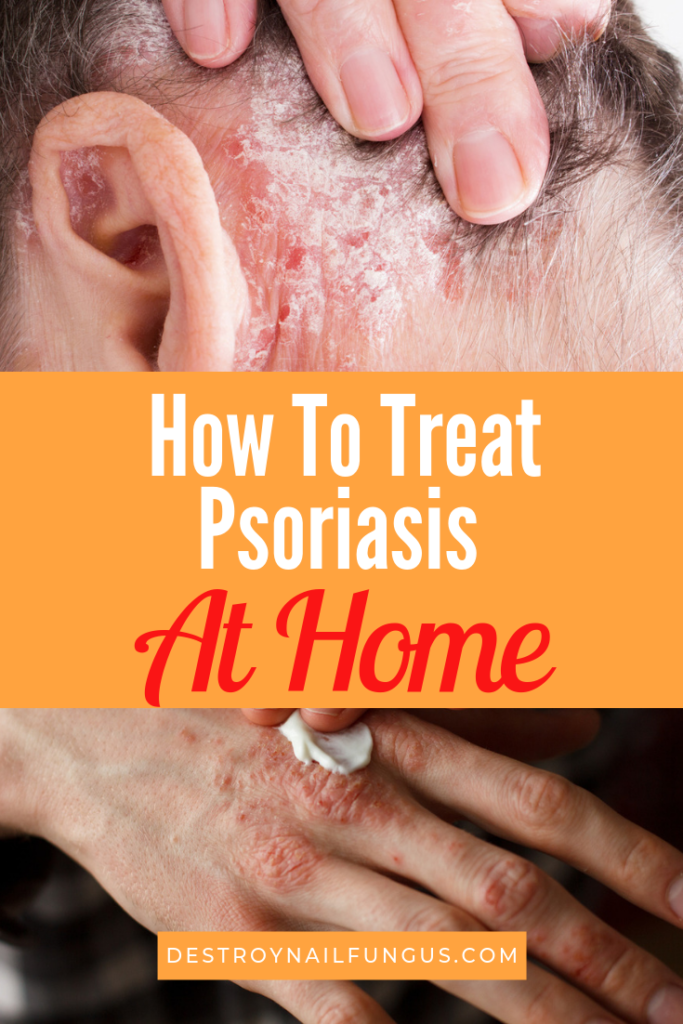 5 Amazing Home Remedies for Psoriasis That You Need To Try Now!