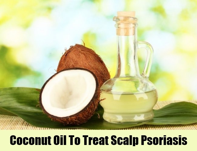 5 Best And Effective Ways For Scalp Psoriasis Treatments ...