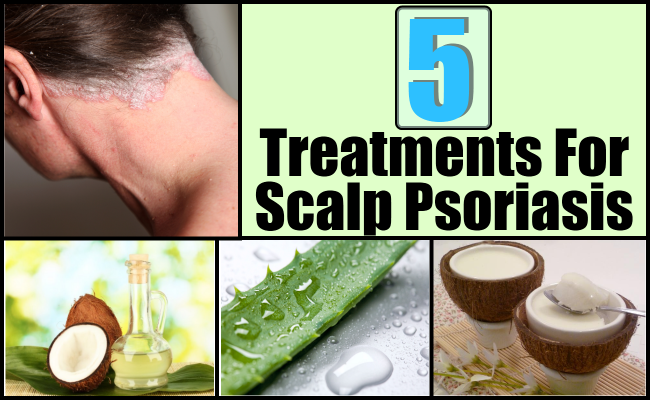5 Best And Effective Ways For Scalp Psoriasis Treatments ...
