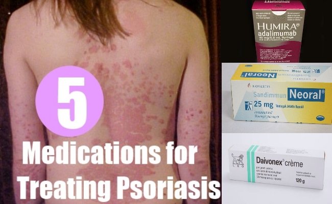 5 Best Drugs and Medications For Treating Psoriasis