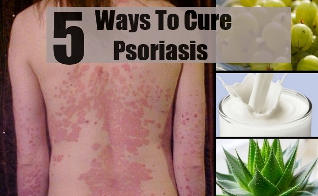 5 Effective Remedies To Cure Psoriasis