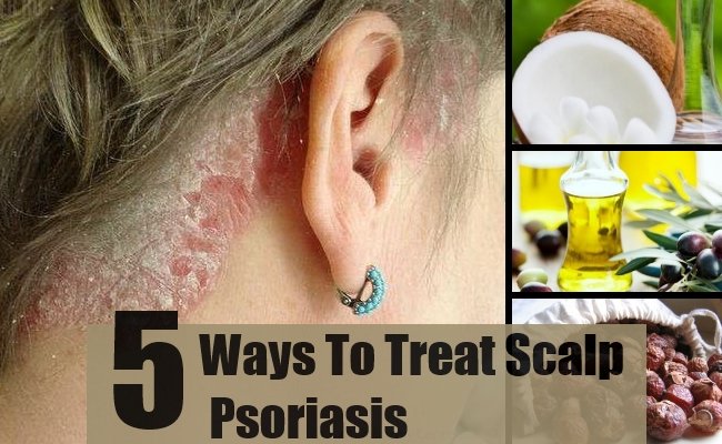 5 Effective Ways For Scalp Psoriasis Treatments