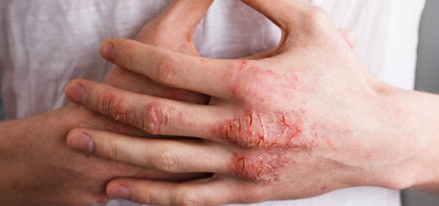 5 Empowering Ways to Manage Your Psoriasis