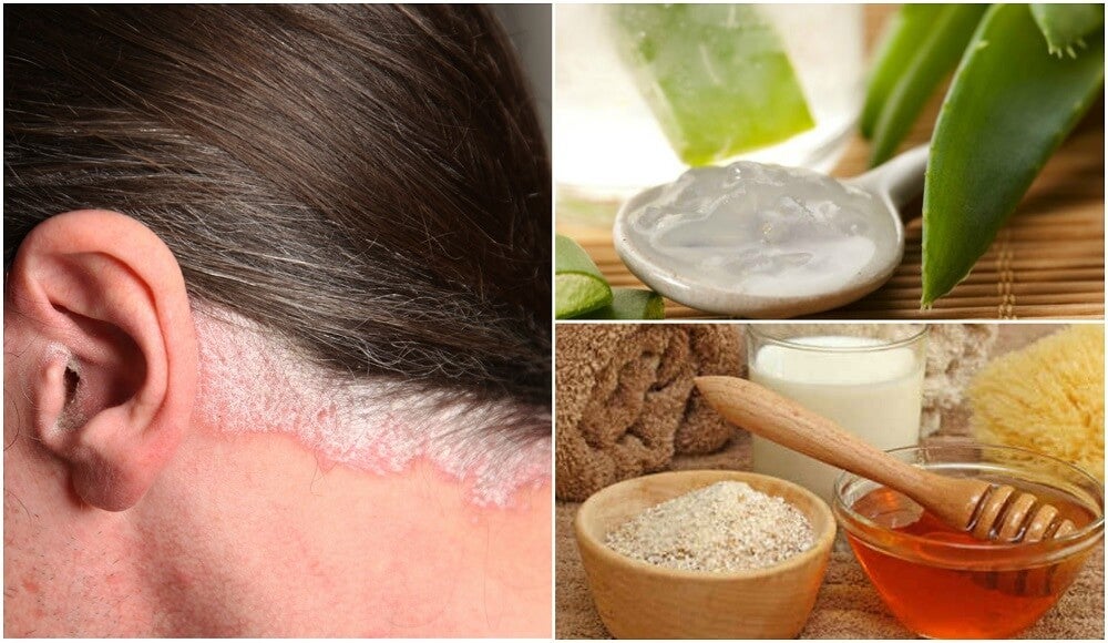 5 remedios caseros para la psoriasis en el cuero cabelludo ...