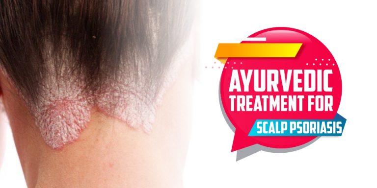 5 Ways Ayurvedic Treatment for Scalp Psoriasis Can Help You