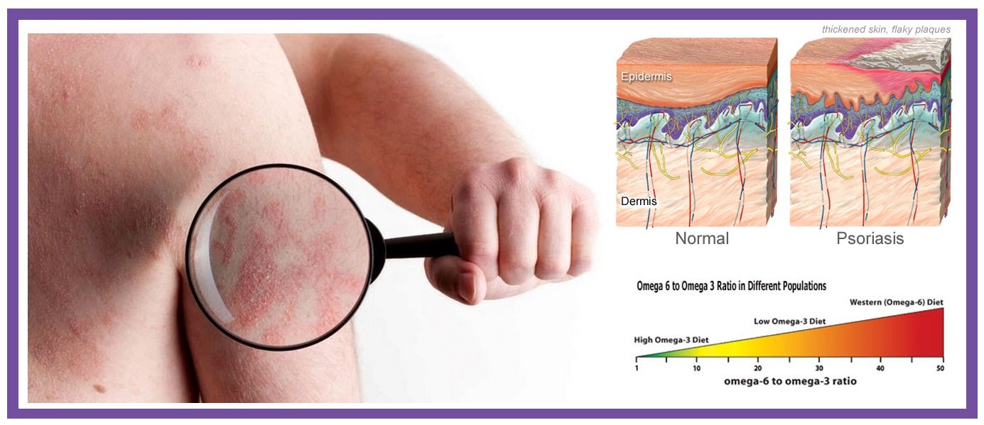 5 Ways to Treat and Prevent Psoriasis Flare