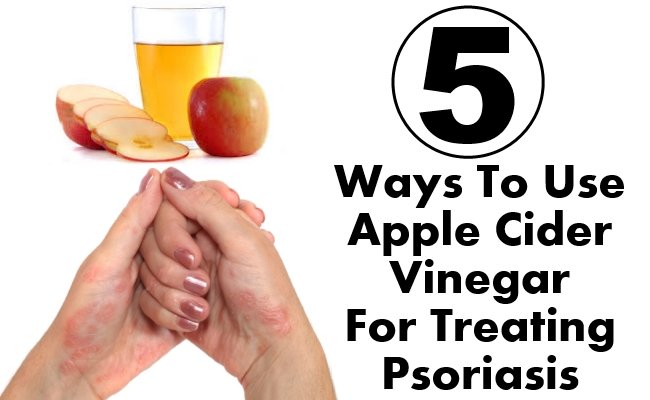 5 Ways To Use Apple Cider Vinegar For Treating Psoriasis ...