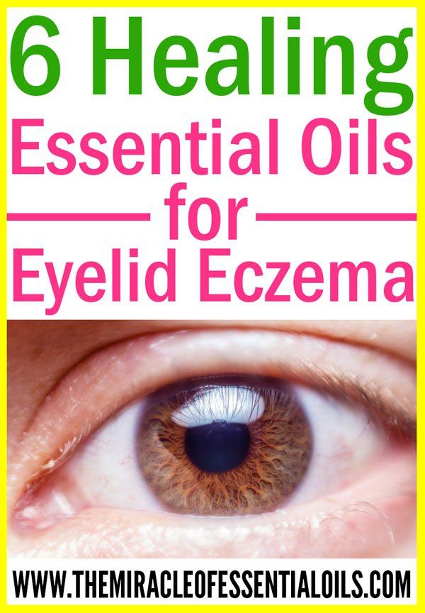 6 Essential Oils for Eczema on Eyelids (plus Healing Cream ...
