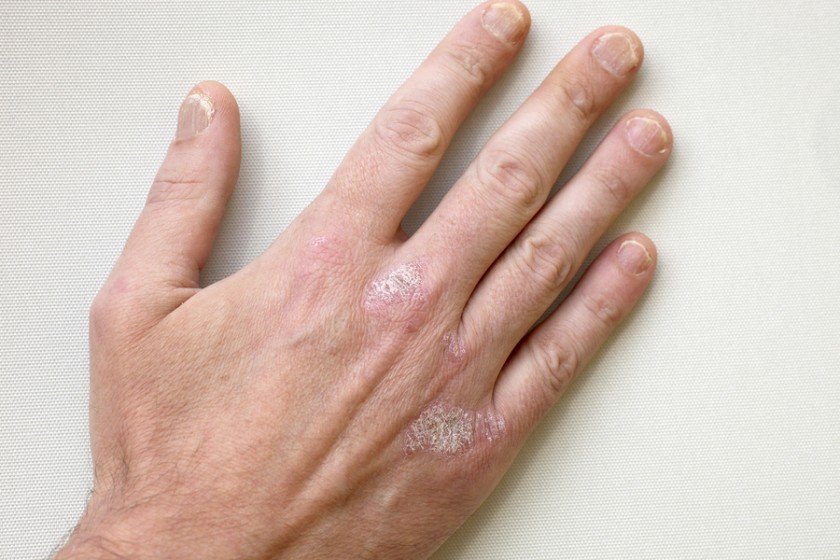 6 Signs of Psoriatic Arthritis â Mega Bored