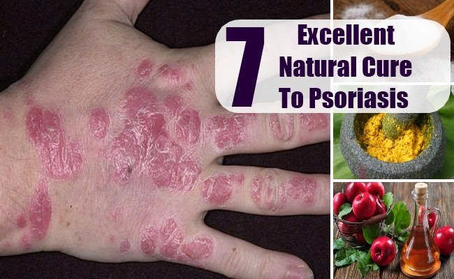 7 Excellent Natural Cure For Psoriasis