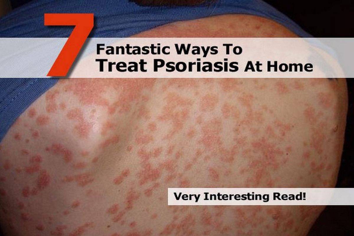 7 Fantastic Ways To Treat Psoriasis At Home