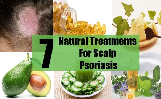 7 Natural Treatments For Scalp Psoriasis