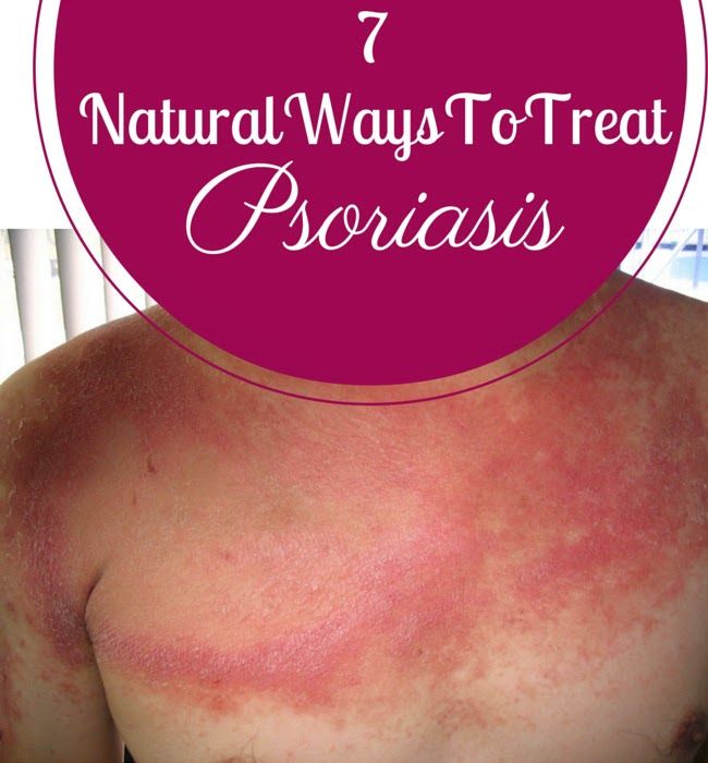 7 Natural Ways To Treat Psoriasis