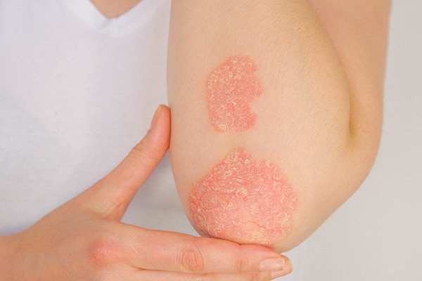 7 Reasons Why You Have Scaly Skin and How to Get Rid of It