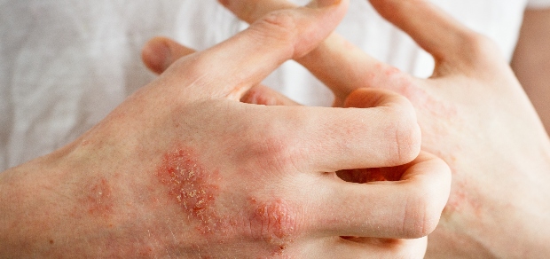 7 Tips for Treating Psoriasis on the Hands