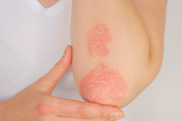 7 types of Psoriasis: Triggers and Symptoms