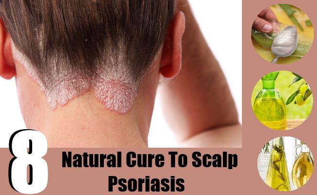 8 Cure For Scalp Psoriasis