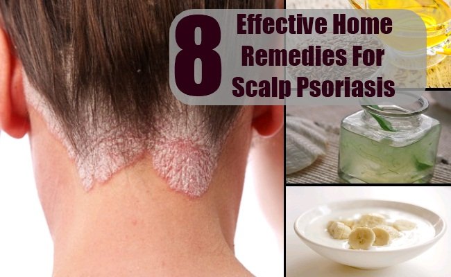 8 Effective Home Remedies For Scalp Psoriasis