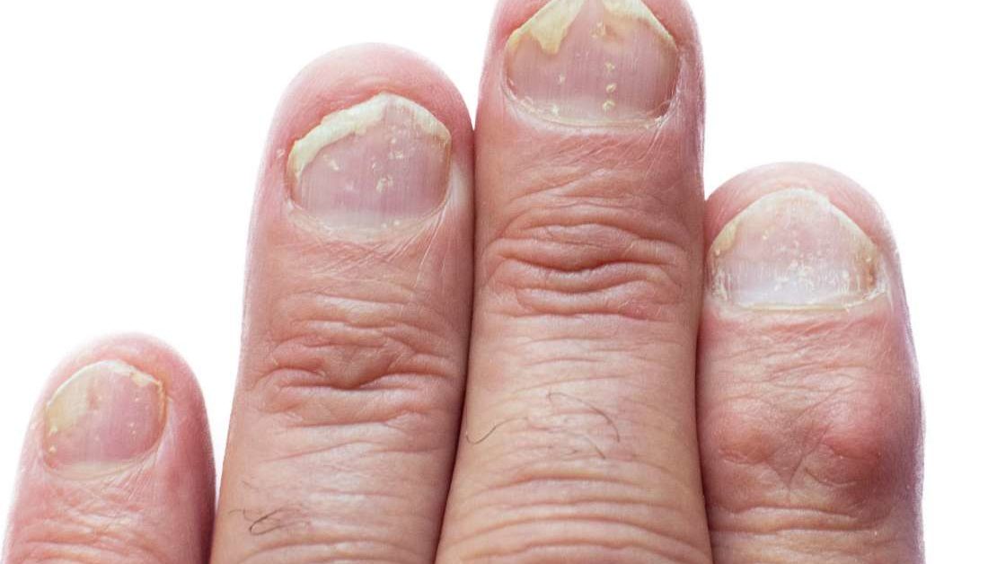 8 effects of psoriatic arthritis on the body