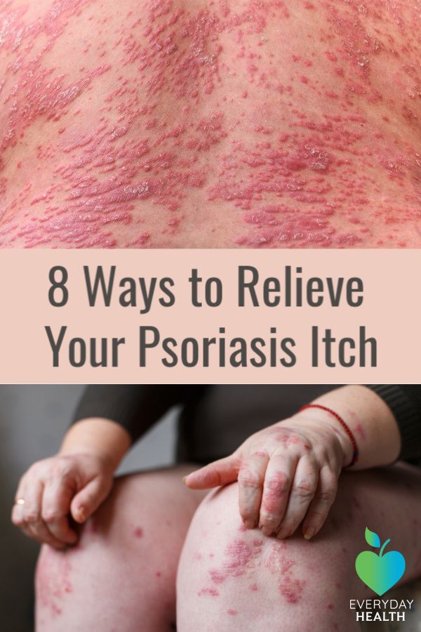 8 Ways to Relieve Psoriasis Itch