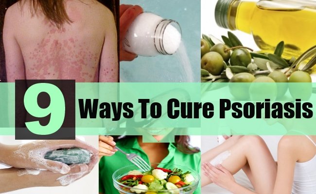 9 Best Ways To Cure Psoriasis