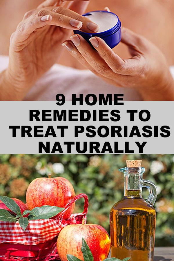 9 HOME REMEDIES TO TREAT PSORIASIS NATURALLY