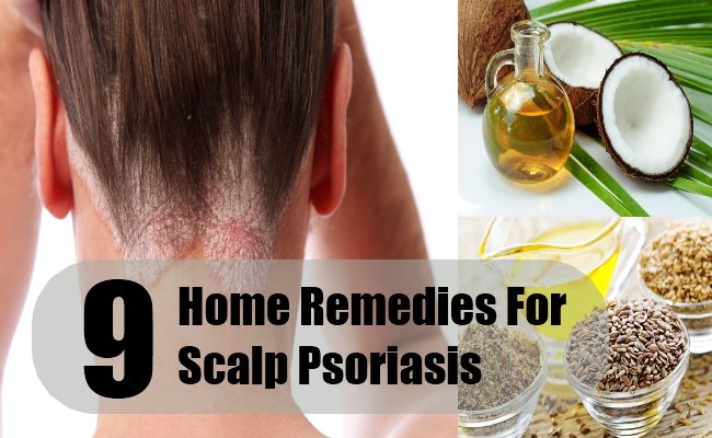 9 Scalp Psoriasis Home Remedies Natural Treatments &  Cures