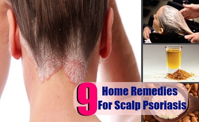 9 Scalp Psoriasis Home Remedies Natural Treatments &  Cures ...
