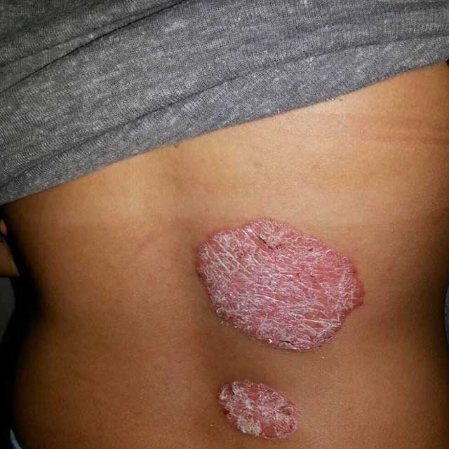A Filipina Shares What Life With Psoriasis Is Really Like