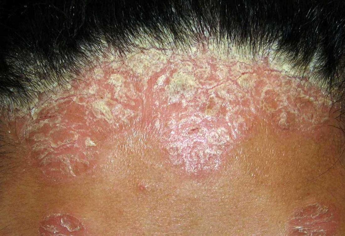 A Guide To Know About Different Types Of Psoriasis ...