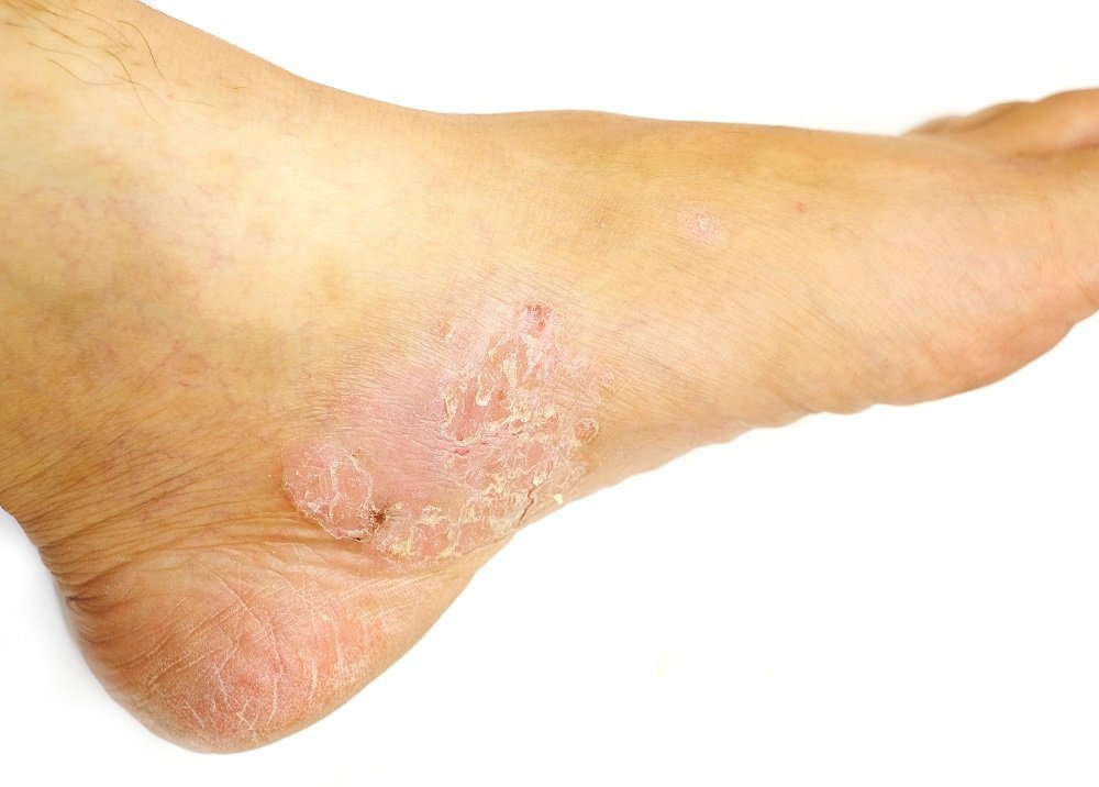 A Guide to Psoriasis on the Foot